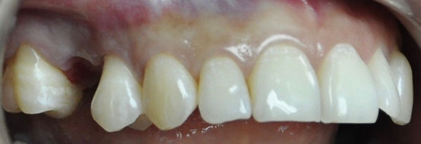 Implantes dentales, Preio de implnates dnetales , precios, implantes dentales, implantes dentales, precios