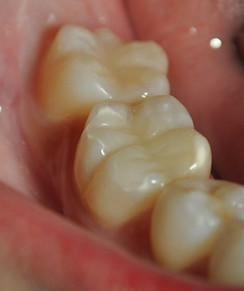 urgencia dental en clinica dental providencia, especilista en implanstes y urgencia dentales