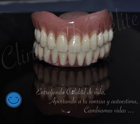 Protesis dental-implantes-dentales-denti