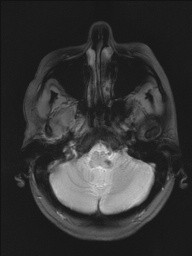 Cavernomas Cerebrais