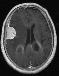 Meningiomas