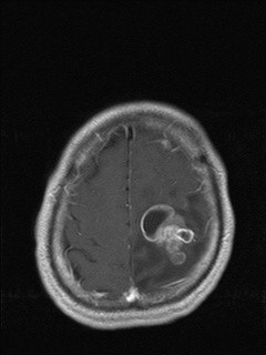 Metástase Cerebral