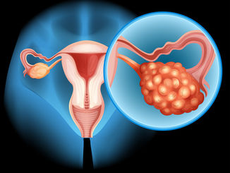 Fibroid Removal
