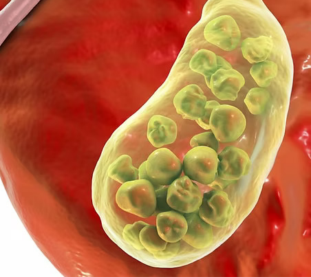 Gall Stones Treatment in Rajahmundry