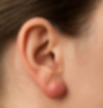 Ear Lumps