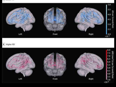 The Impact of Screen Time on Brain Development in Preschoolers