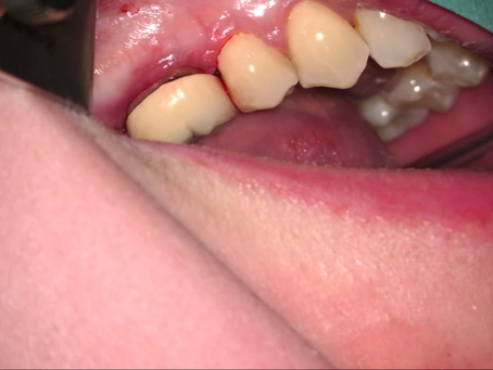 36 danties apekso rezekcija