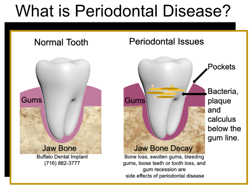 Buffalo Dental Implant - perio disease