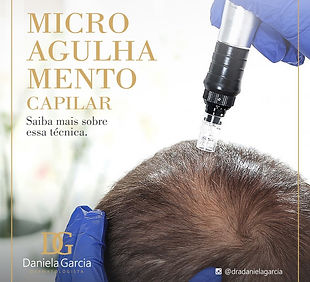 Microagulhamento Capilar