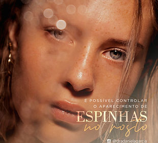 Tratamento de Acne