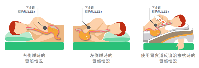 胃食道反流治療枕的原理