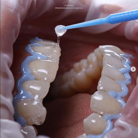 dentista centro rj - Clareamento Dental