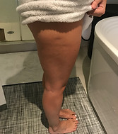 Lauren M Before-Cellulite.JPG