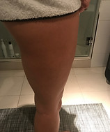 Lauren M After-Cellulite.JPG