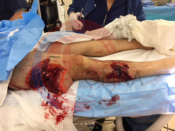 OMNA Marine Tourniquet (OMT) is the ideal tourniquet to deal with marine trauma