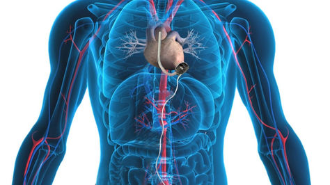 Lead Advisor Eaton Capital supports CardioLife’s Left Ventricular Assist Device Revolution in India