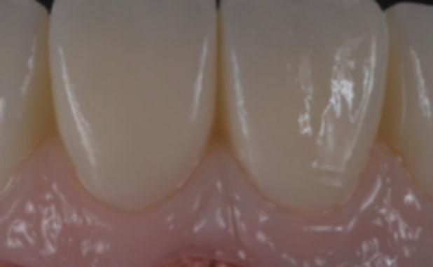 IMPLANT ZIRCONIA.jpeg