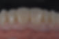 IMPLANT ZIRCONIA.jpeg