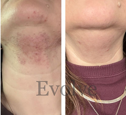 laser hair removal cleveland ga