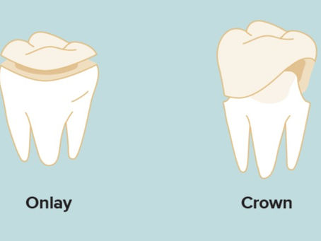 Onlays Vs Crowns