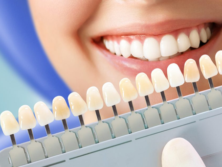 What you need to know about teeth whitening!