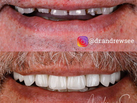 3 easy ways to stop teeth getting shorter