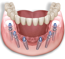 full-arch-dental-implant-model-300x251.png