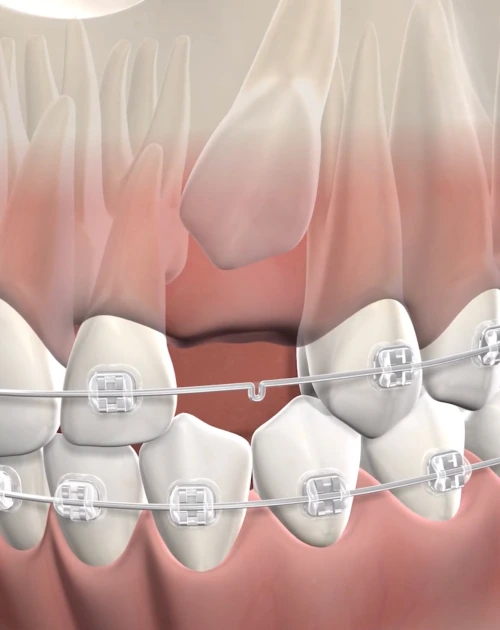 ortho-impacted-canines-procedure-mobile.webp