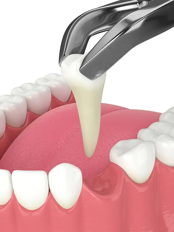 tooth-extraction-5.webp