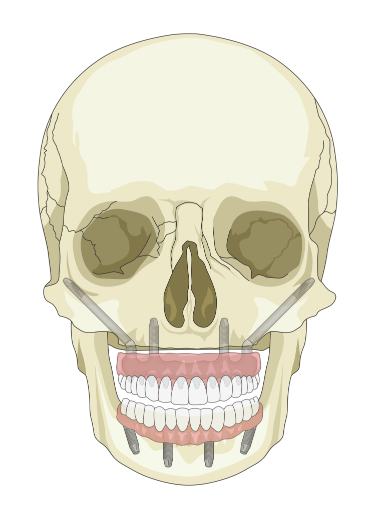 3-Zygomatic-Dental-Implants-in-upper-jaw-t-749x1024 (1).png