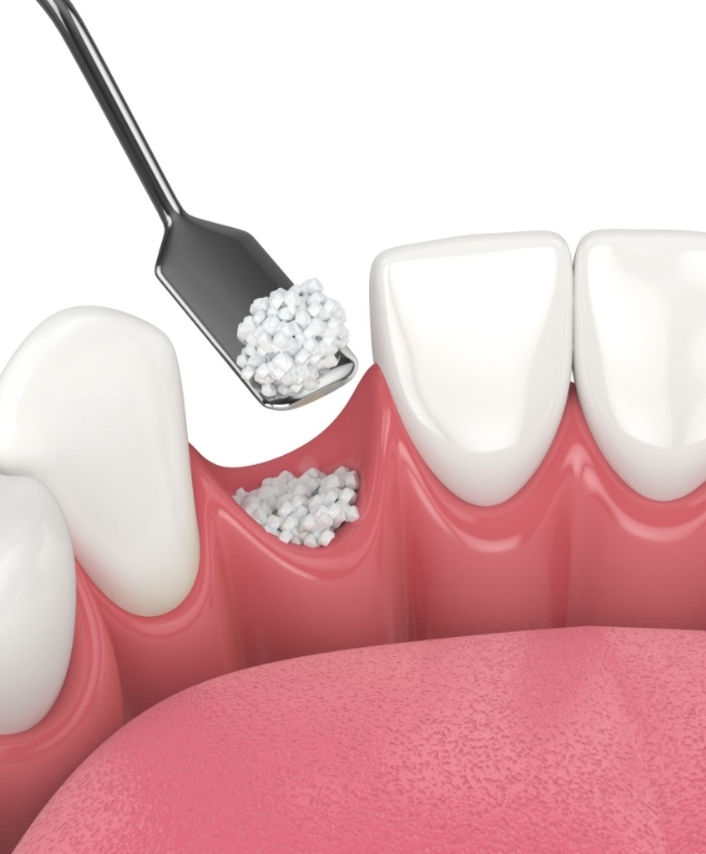 bone-grafting-1.jpg