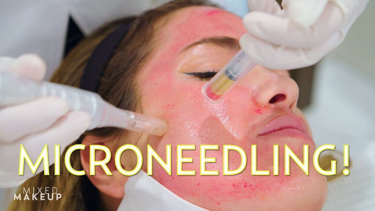 PRP Microneedling
