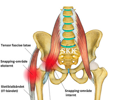 snapping hip syndrom anatomisk bilde av internt og eksternt snapping av iliopsoas og iliotobial band