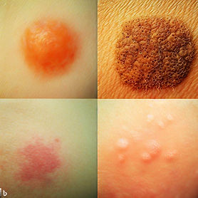 SKIN CANCER