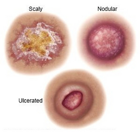 SKIN CANCER