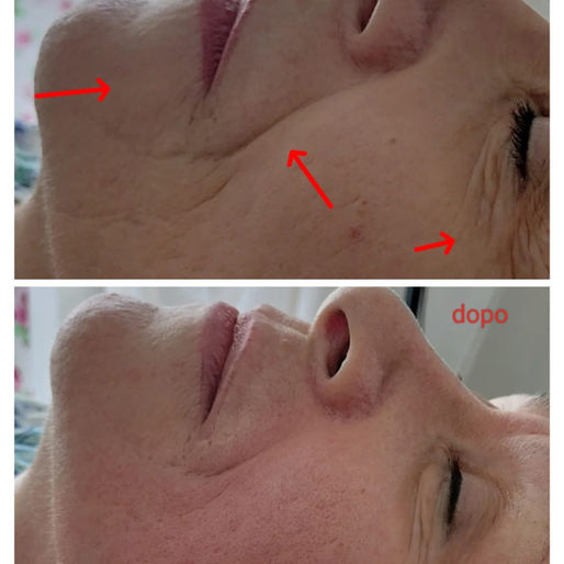 Come Cancellare le Rughe Naso-Labiali in Modo Naturale: Trucchi e Tecniche Efficaci