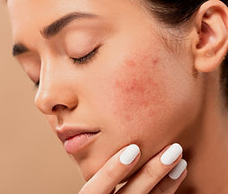Acne & Skin Disorders 1.jpg