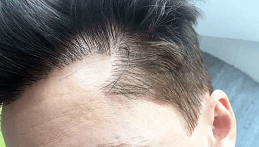 "كيفية تقييم أفضل مراكز زراعة الشعر: أسئلة يجب طرحها"