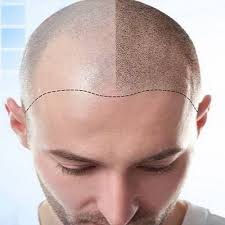 الآثار الجانبية لزراعة الشعر التي يجب أن تعرفها