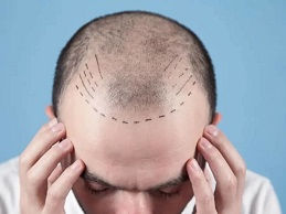 طريقة زراعة الشعر الدائمة