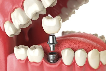 Dental Implant Dental Clinic Shela
