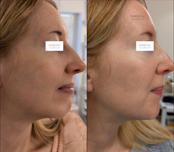 Exosome Microneedling