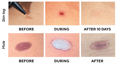 Stages of healing cryotherapy
