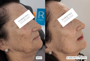 Bio-stimulators - one session