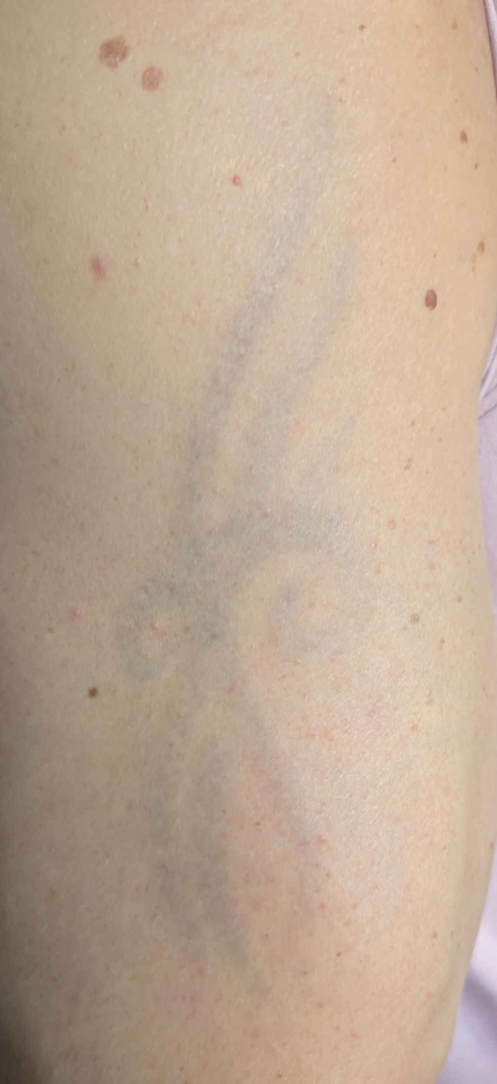Tattoo removal