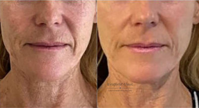 Exosomes on face and Neck