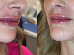 What You Need to Know About Lip Injections