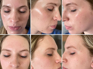 Preparing Your Skin for a Chemical Peel