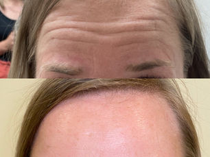 Botox vs. Xeomin vs Dysport: What’s the Difference?