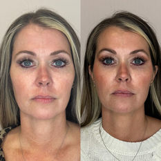 Amber Wray performing facial balancing injections to harmonize facial proportions and enhance facial symmetry